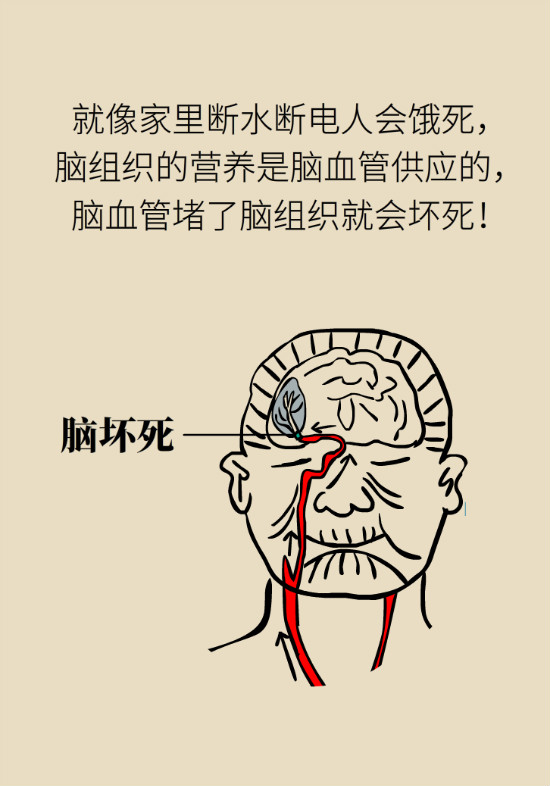 腔隙性腦梗死一定是腦血管堵了嗎？