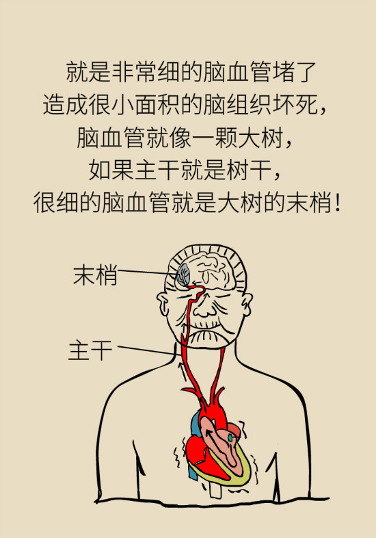 腔隙性腦梗死一定是腦血管堵了嗎？