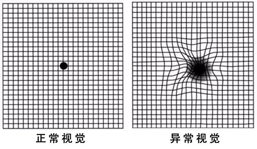 糖尿病患者出現(xiàn)這個(gè)癥狀，可能是失明前兆