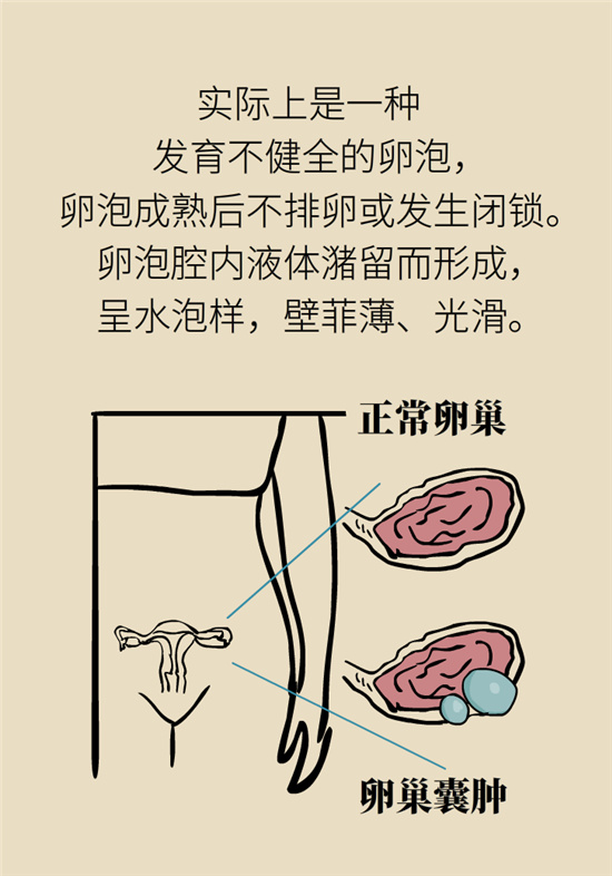 卵巢囊腫科普動漫：卵巢囊腫是腫瘤嗎？要學會這樣區(qū)分