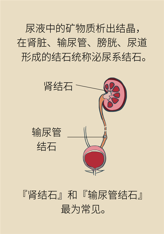 結石科普：身體里多了各種結石，應該怎么辦？