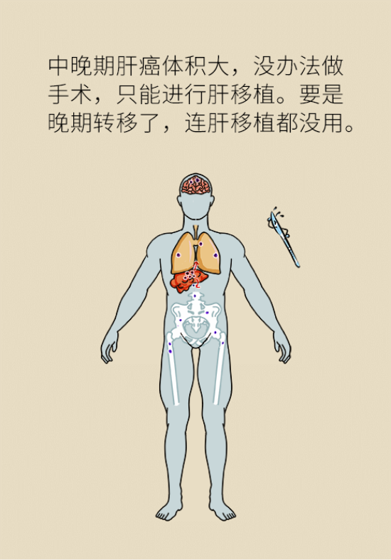 論發(fā)現(xiàn)早期肝癌的本事，cfDNA比AFP更精準(zhǔn)，比影像學(xué)更早一步