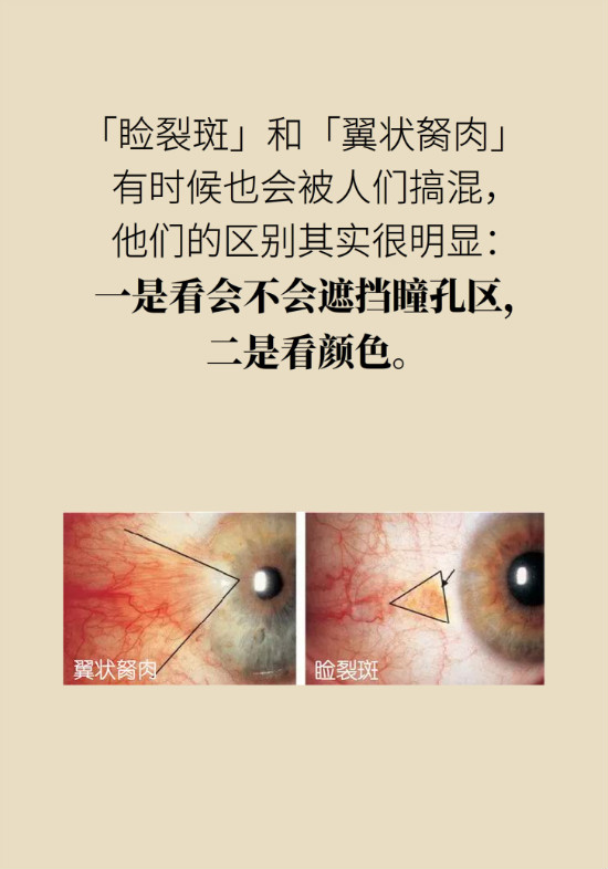 眼白有斑塊、出血要緊嗎？專家：名字唬人但問題不大