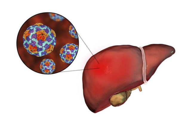 世界肝炎日：得了肝炎一定會得肝癌嗎？