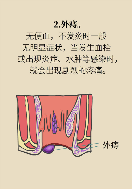 長(zhǎng)“痔”如何久安？專家的建議來了