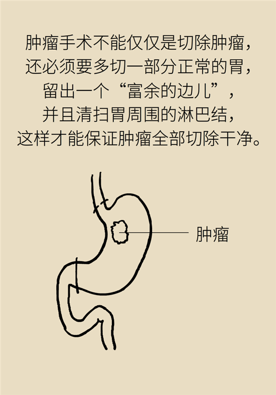 胃癌手術(shù)一定要全切胃？專家：視情況而定