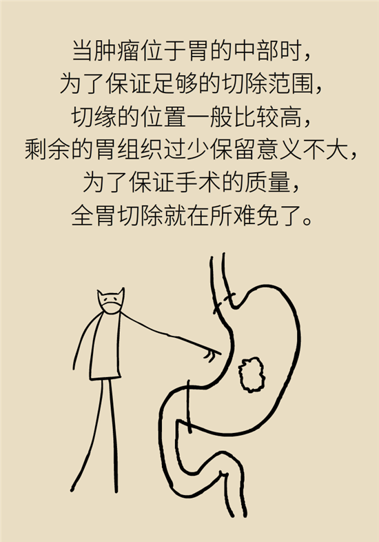 胃癌手術(shù)一定要全切胃？專家：視情況而定