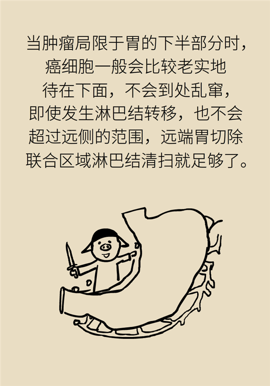 胃癌手術(shù)一定要全切胃？專家：視情況而定