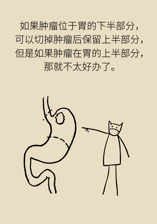 胃癌手術(shù)一定要全切胃？專家：視情況而定
