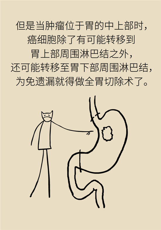 胃癌手術(shù)一定要全切胃？專家：視情況而定