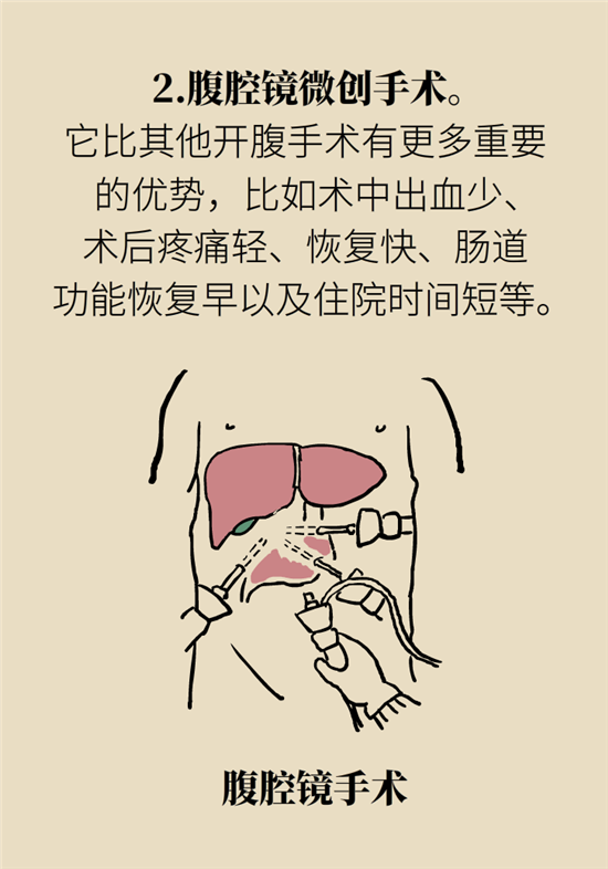胃癌手術(shù)一定要全切胃？專家：視情況而定