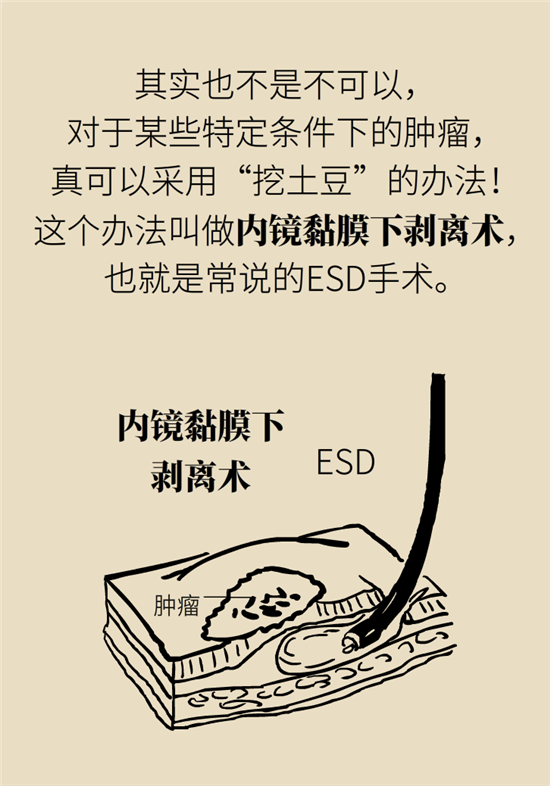 胃癌手術(shù)一定要全切胃？專家：視情況而定