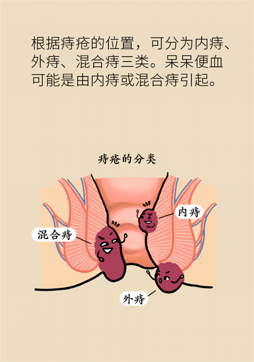 肛門腫脹還有血？小心痔瘡找上門