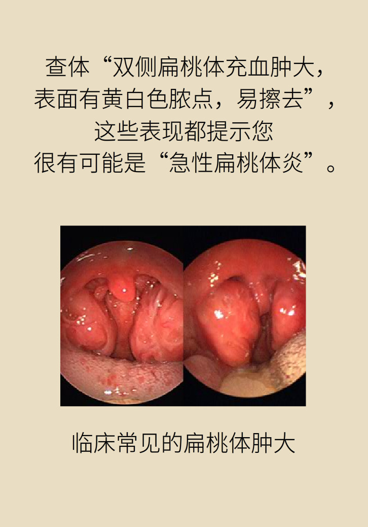 單側(cè)扁桃體腫大更兇險(xiǎn)！謹(jǐn)防惡性腫瘤