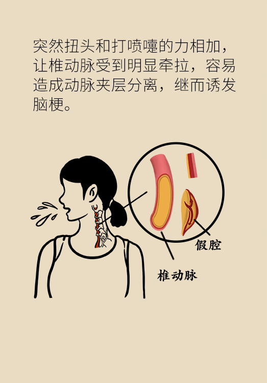 腦梗醫(yī)學(xué)科普動(dòng)漫設(shè)計(jì)